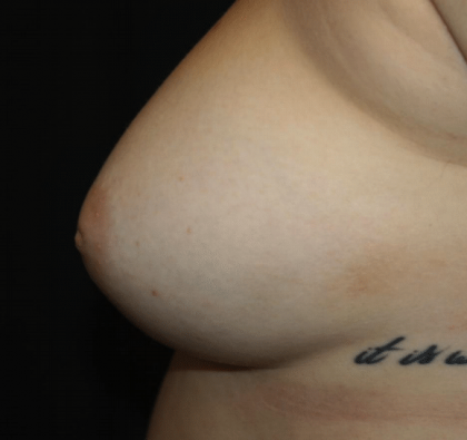 Nipple Revision Before & After Patient #30192