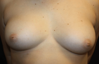 Nipple Revision Before & After Patient #30192
