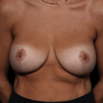 Breast Augmentation Before & After Patient #30235