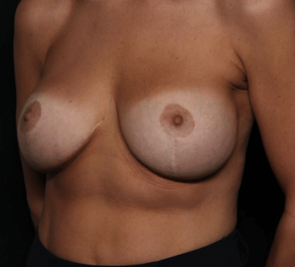 Breast Augmentation Before & After Patient #30235