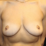 Breast Augmentation Before & After Patient #30235