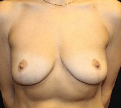 Breast Augmentation Before & After Patient #30235