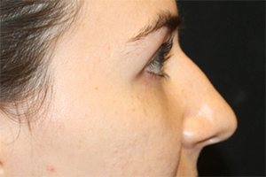 Rhinoplasty Before & After Patient #30224