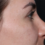 Rhinoplasty Before & After Patient #30224