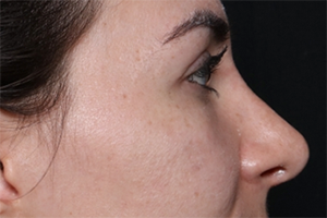 Rhinoplasty Before & After Patient #30224