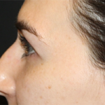 Rhinoplasty Before & After Patient #30224