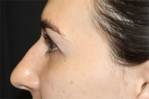 Rhinoplasty Before & After Patient #30224