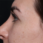 Rhinoplasty Before & After Patient #30224