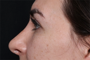 Rhinoplasty Before & After Patient #30224