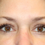 Blepharoplasty Before & After Patient #30581