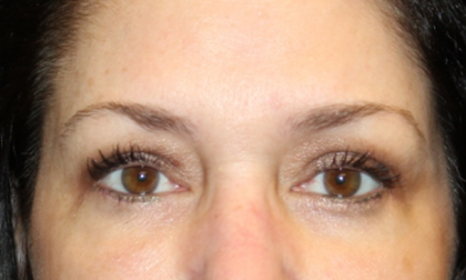 Blepharoplasty Before & After Patient #30581