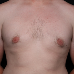 Gynecomastia Before & After Patient #30625