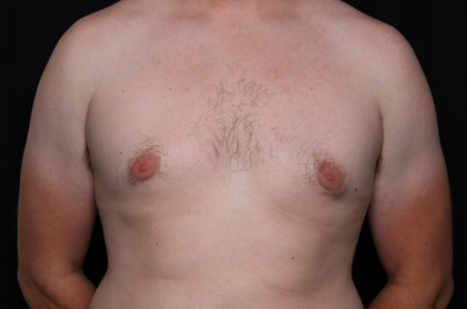 Gynecomastia Before & After Patient #30625