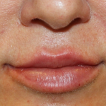 Lip Filler Before & After Patient #30636