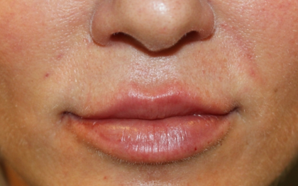 Lip Filler Before & After Patient #30636