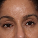 Brow Lift Before & After Patient #30678