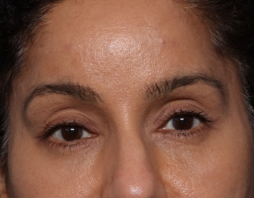 Brow Lift Before & After Patient #30678