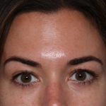 Botox and Dysport Before & After Patient #30471