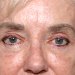Blepharoplasty and Brow Lift Before & After Patient #30496