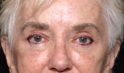 Blepharoplasty and Brow Lift Before & After Patient #30496