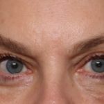 Blepharoplasty Before & After Patient #30512