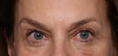 Blepharoplasty Before & After Patient #30512