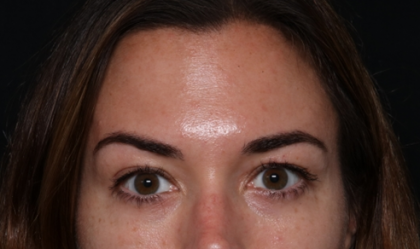 Botox and Dysport Before & After Patient #30471