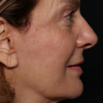 Facelift Before & After Patient #30487