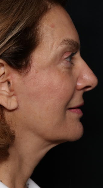 Facelift Before & After Patient #30487