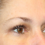 Blepharoplasty Before & After Patient #30581