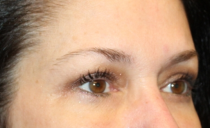 Blepharoplasty Before & After Patient #30581