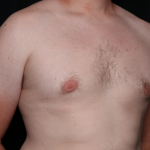 Gynecomastia Before & After Patient #30625