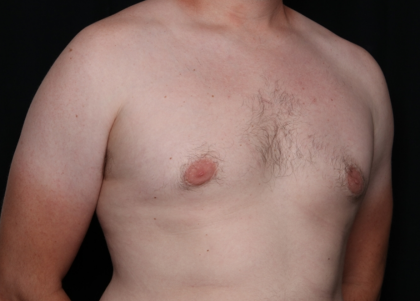 Gynecomastia Before & After Patient #30625