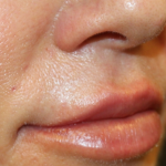 Lip Filler Before & After Patient #30636