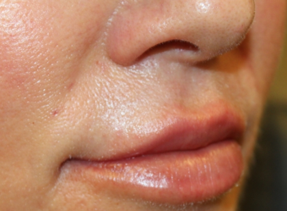 Lip Filler Before & After Patient #30636