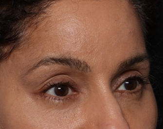 Brow Lift Before & After Patient #30678