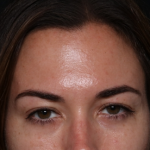 Botox and Dysport Before & After Patient #30471