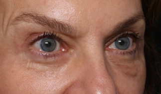 Blepharoplasty Before & After Patient #30512