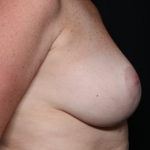 Breast Lift Before & After Patient #30523