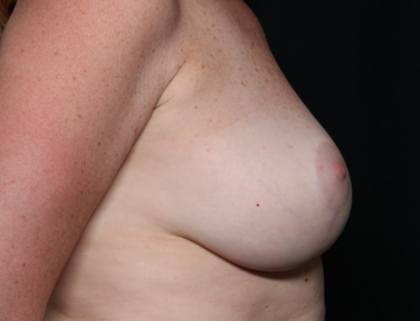 Breast Lift Before & After Patient #30523