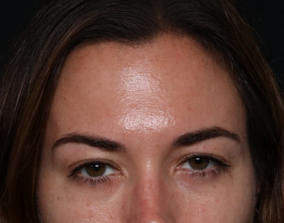 Botox and Dysport Before & After Patient #30471