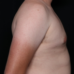 Gynecomastia Before & After Patient #30625