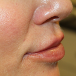 Lip Filler Before & After Patient #30636