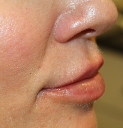 Lip Filler Before & After Patient #30636