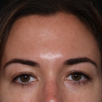 Botox and Dysport Before & After Patient #30471