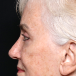 Blepharoplasty and Brow Lift Before & After Patient #30496