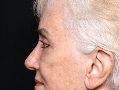 Blepharoplasty and Brow Lift Before & After Patient #30496