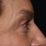 Blepharoplasty Before & After Patient #30512