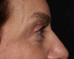 Blepharoplasty Before & After Patient #30512