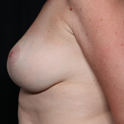 Breast Lift Before & After Patient #30523